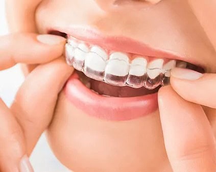 Alineadores invisibles