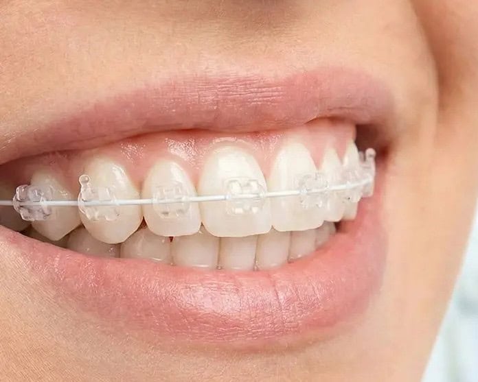 Ortodoncia estética